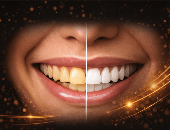 Teeth Whitening